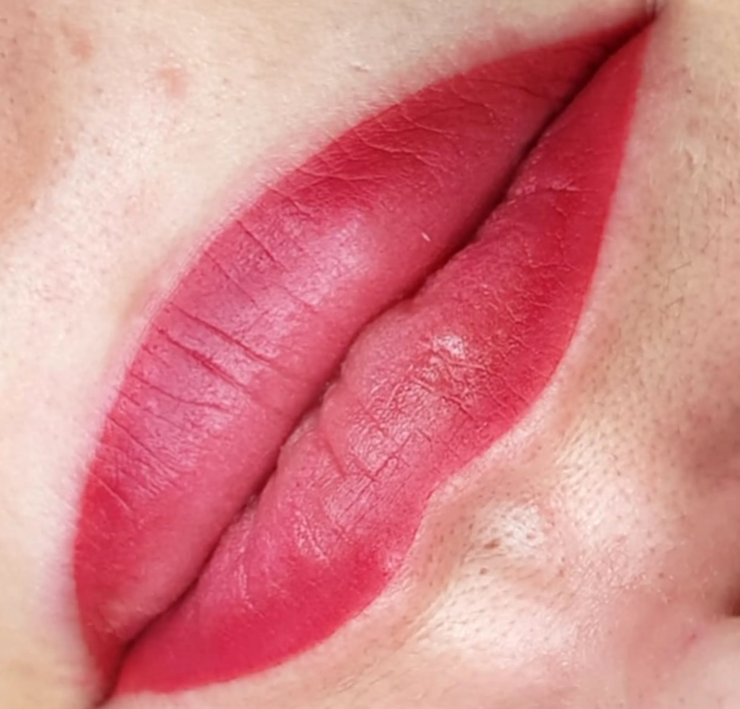 bad lip tattoo removal