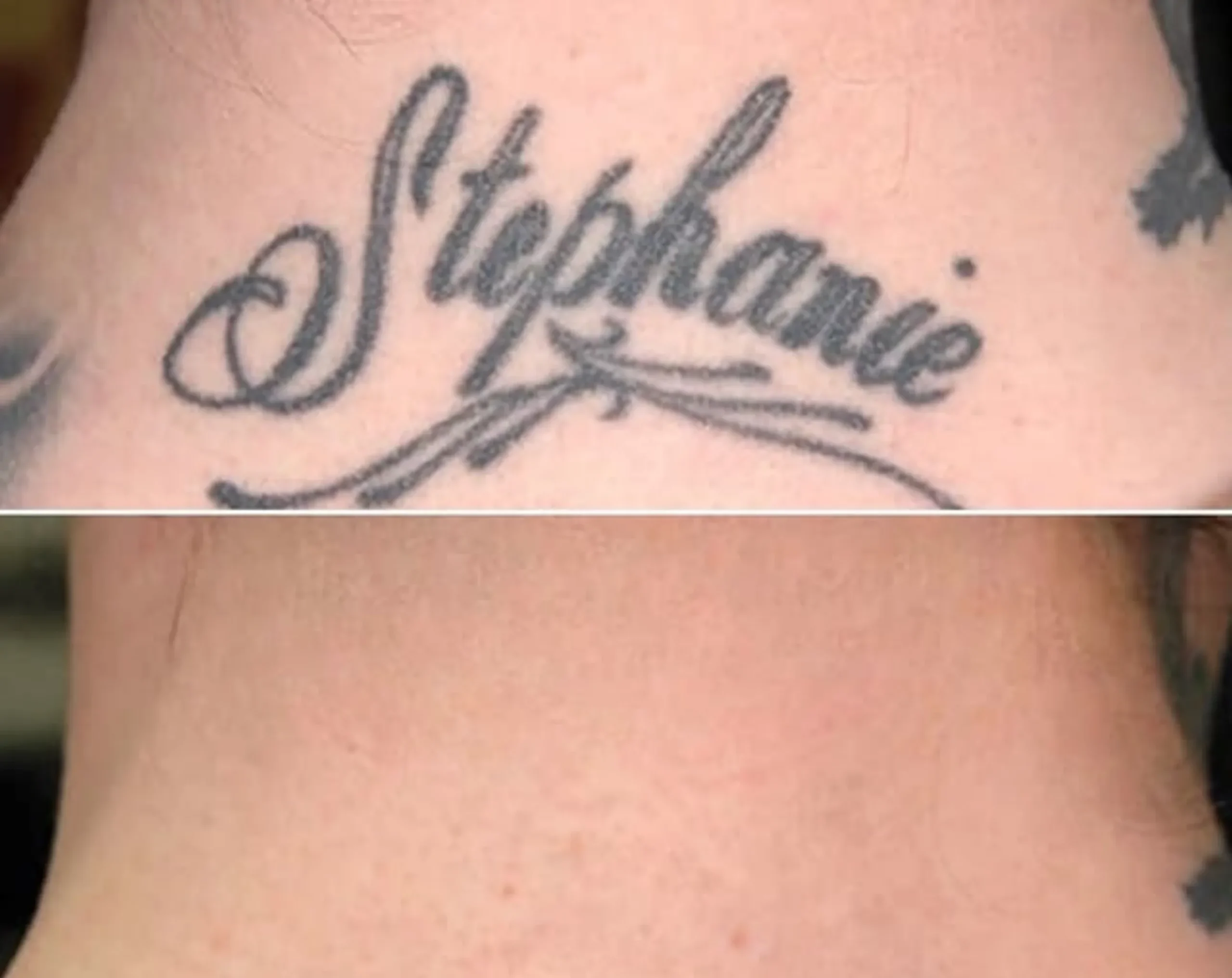laser tattoo patch test cost