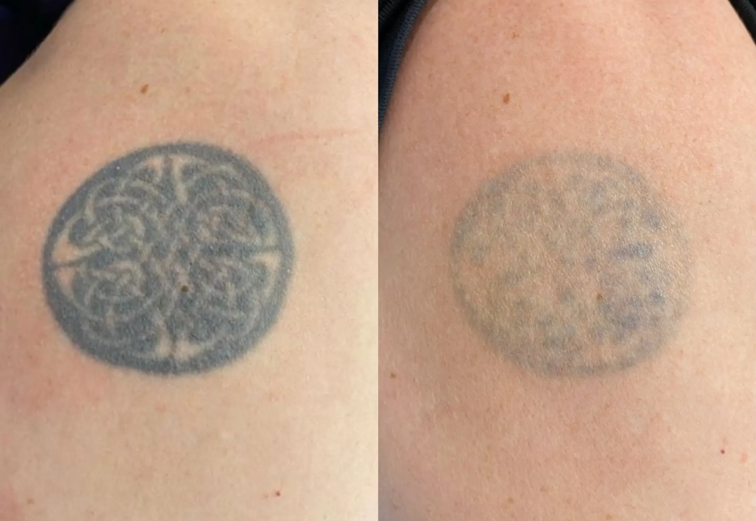 saline vs laser patch test