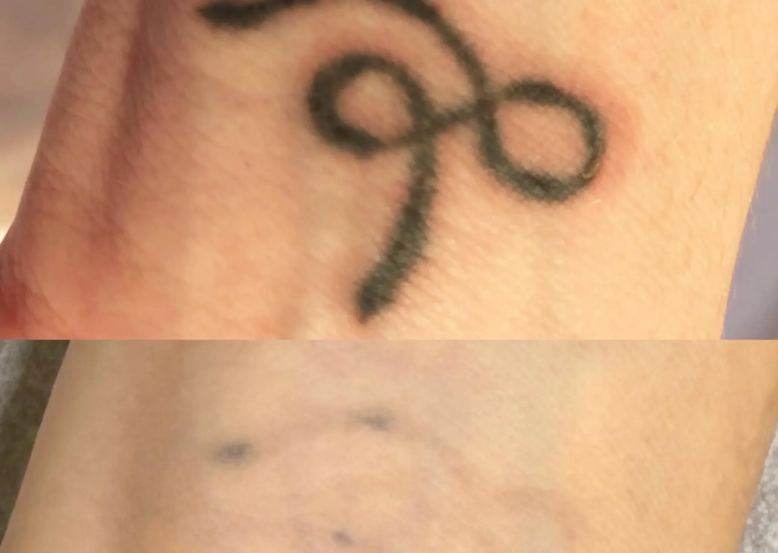 sensitive skin tattoo removal test