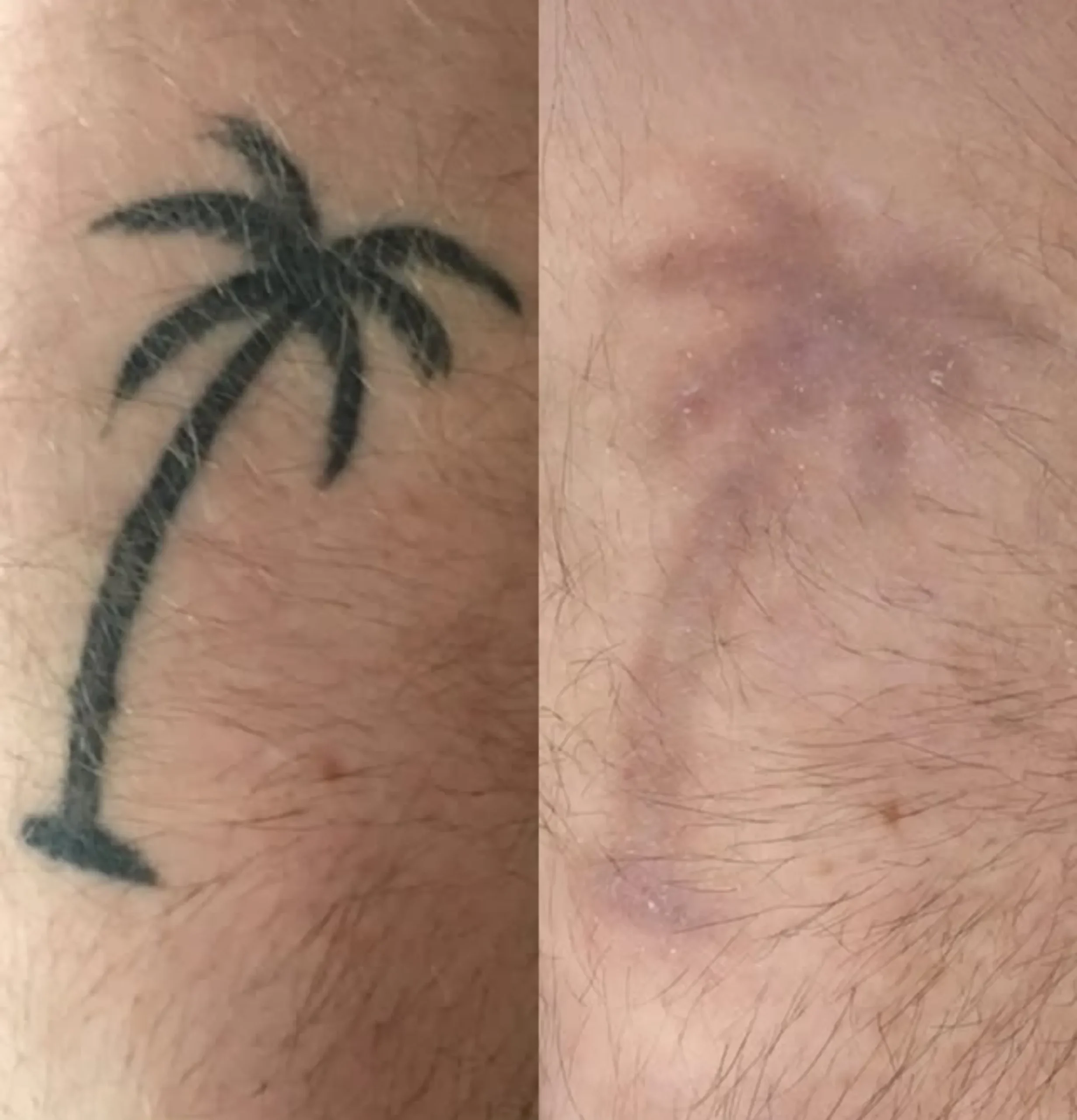 tattoo removal patch test Melbourne